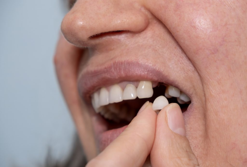 The Perfect Way to Replace Missing Teeth