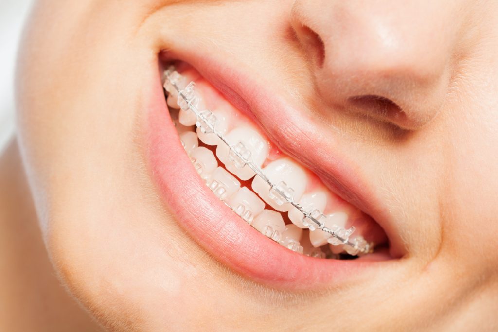 What is Six Month Smiles?